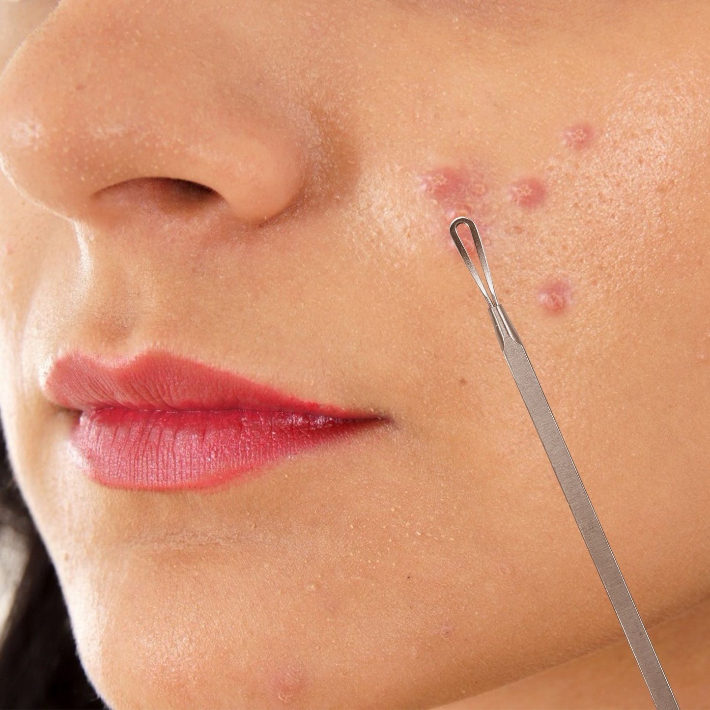7 Pcs Blackhead Remover Kit Stainless Steel